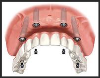 Denture Support