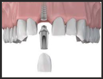 Dental implants